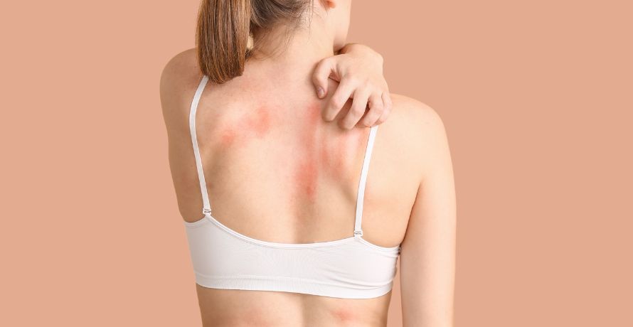 Atopische Dermatitis richtig erkennen