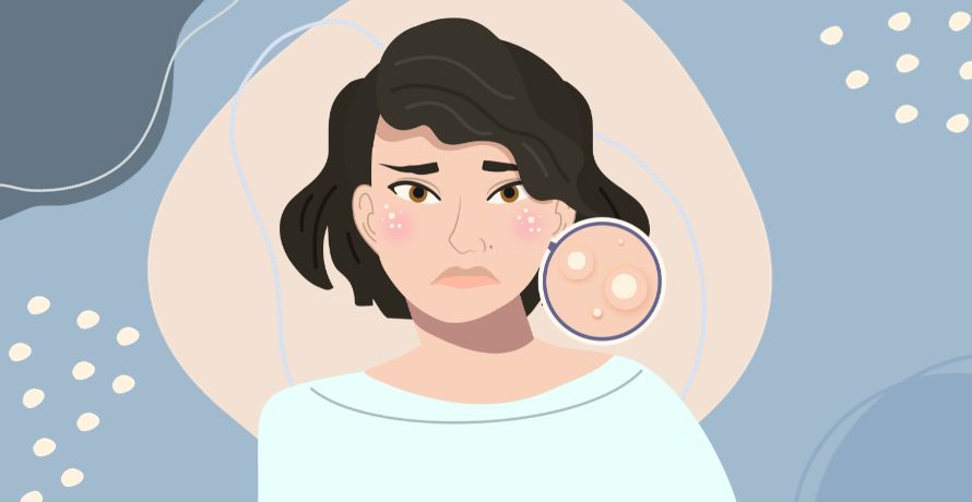 Behandlung von Milien