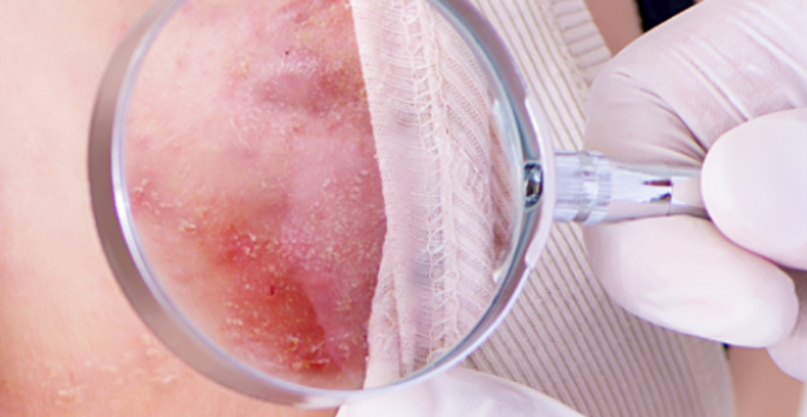 Acne inversa richtig behandeln