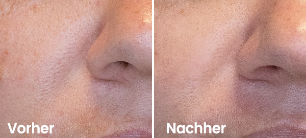 Result Hydrafacial Nasolabial fold