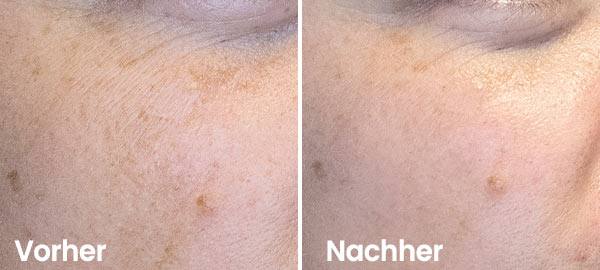 Result Hydrafacial Pigment spots