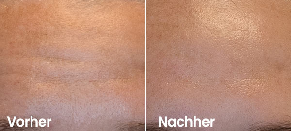 Reduce forehead wrinkles with hydrafacial treatment