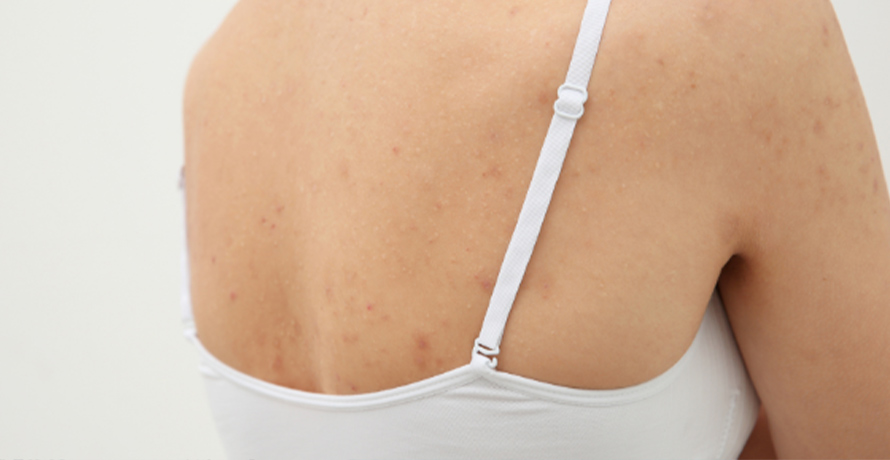 So wirst du Pickel am Rücken los 