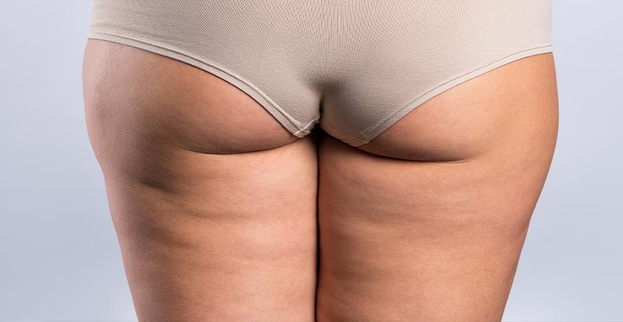 Tipps gegen Cellulite
