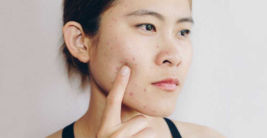 Pickelmale loswerden 