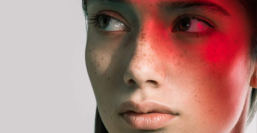 Die Ursache von Rötungen im Gesicht