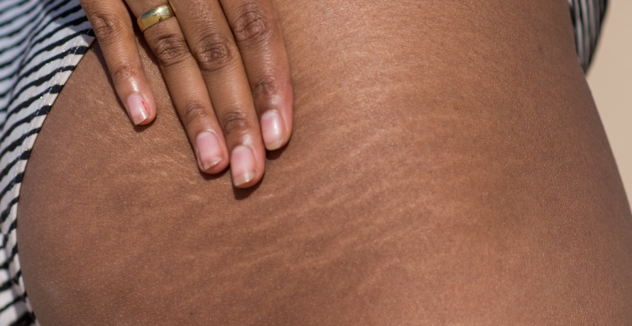 Ursache von Dehnungsstreifen 