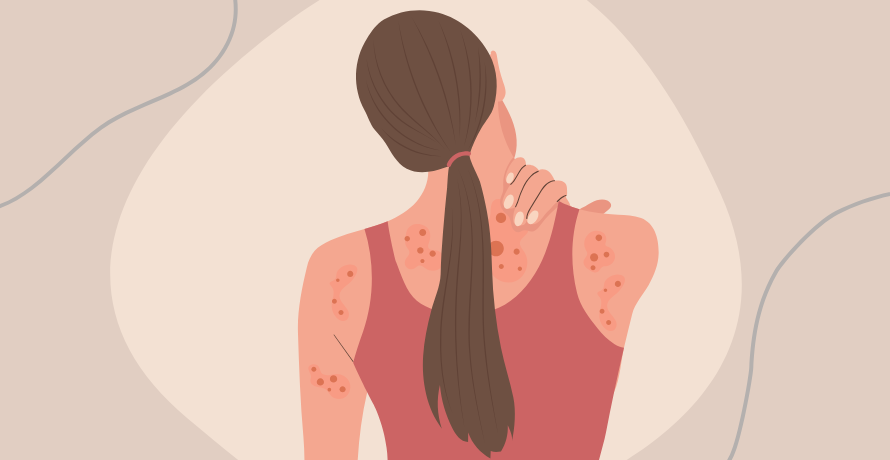 Ursache und Behandlung von Schuppenflechte 