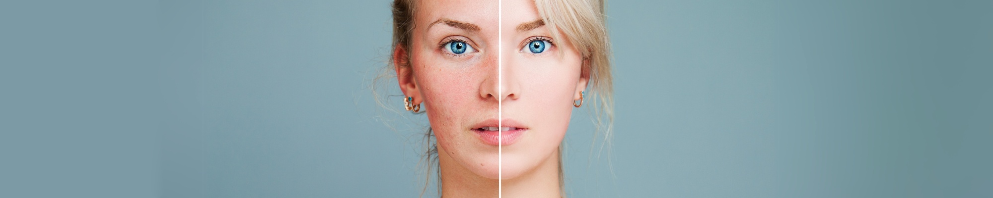 Die richtige Behandlung bei Rosacea